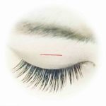 二重整形プチ切開とは？？腫れや傷跡、仕上がり、効果は永久か？？