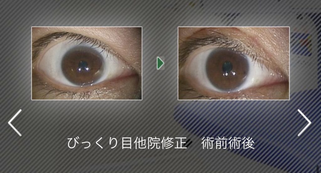 眼瞼下垂の過矯正（びっくり目）は修正できる？原因・修正手術を解説