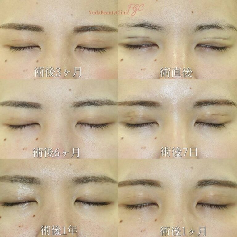 二重幅を広くした二重修正症例・別角度・術後経過写真3｜CASE 4