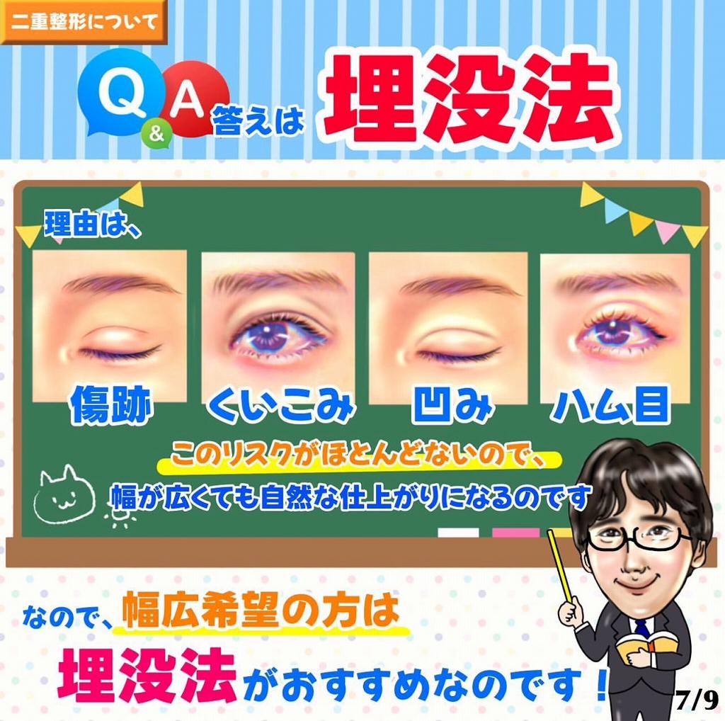 幅広二重は埋没法が良い