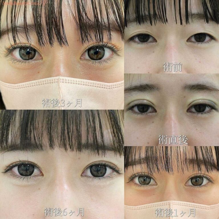 二重幅を広くした二重修正症例・別角度・術後経過写真2｜CASE 49