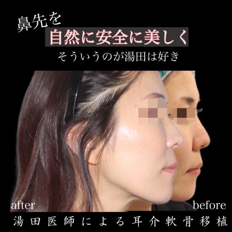 鼻先整形　耳介軟骨移植２・代表画像
