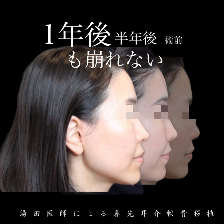鼻先整形　耳介軟骨移植３・代表画像