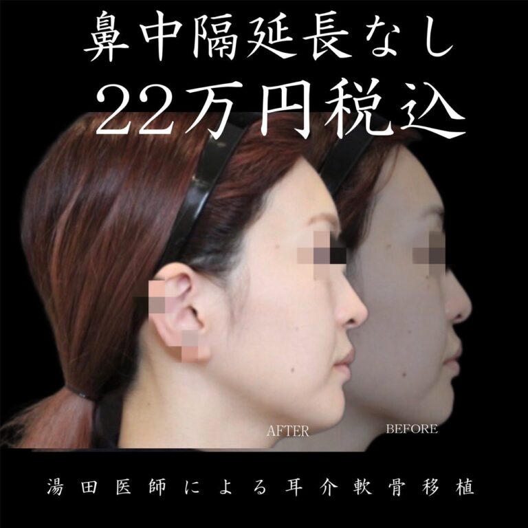 鼻先整形　耳介軟骨移植１・代表画像