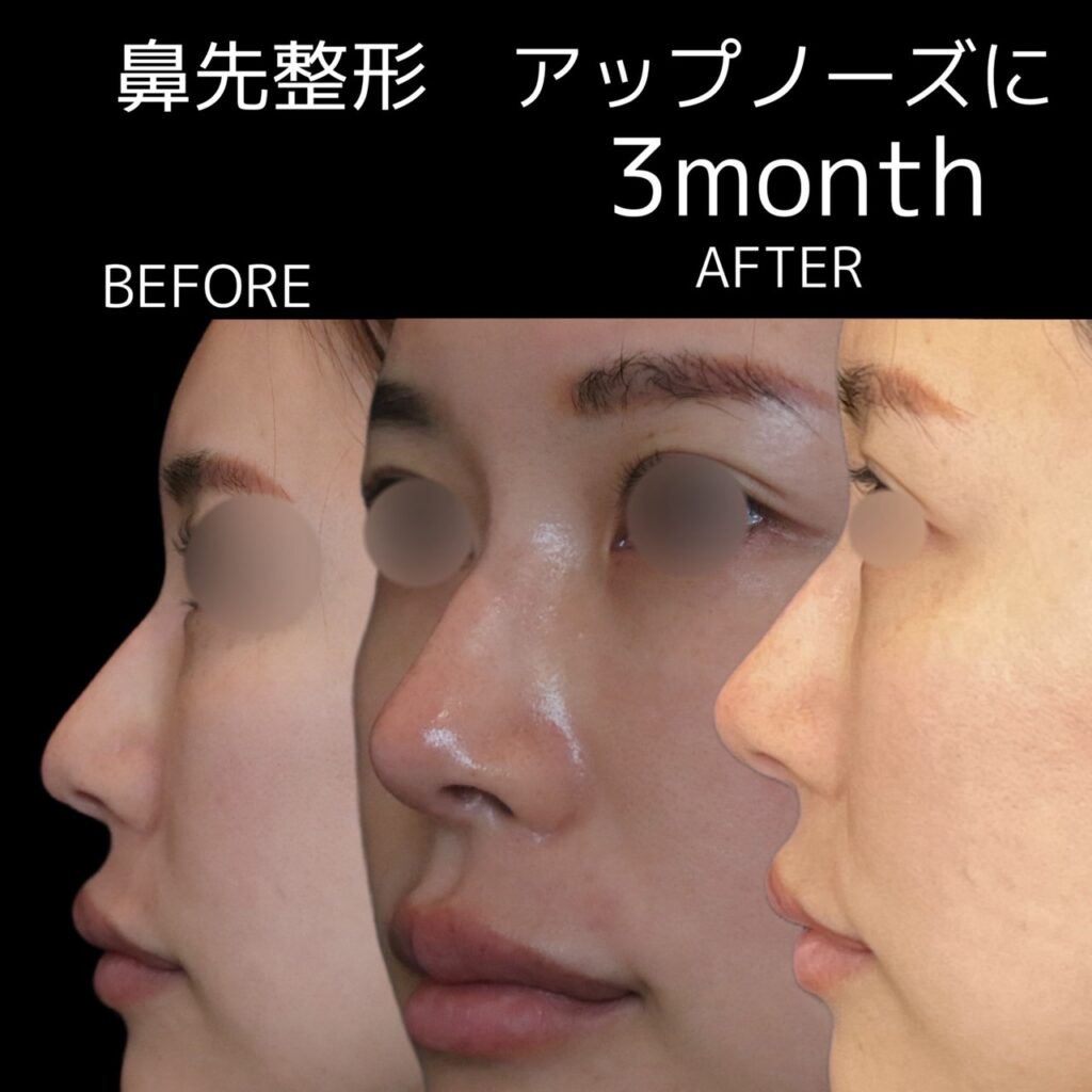 鼻先整形　耳介軟骨移植４