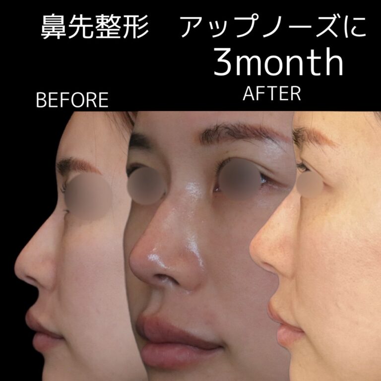 鼻先整形　耳介軟骨移植４・代表画像