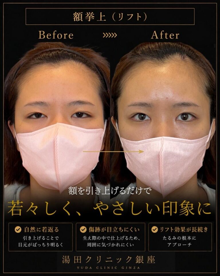 額挙上症例・別角度・術後経過写真2｜CASE 180