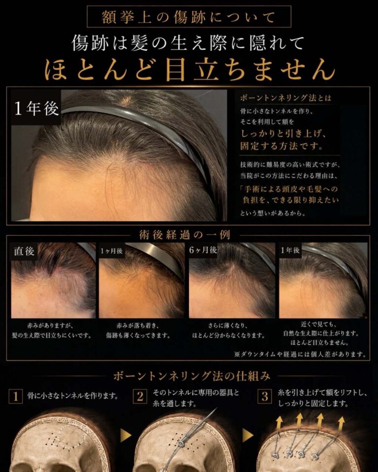 額挙上症例・別角度・術後経過写真4｜CASE 180