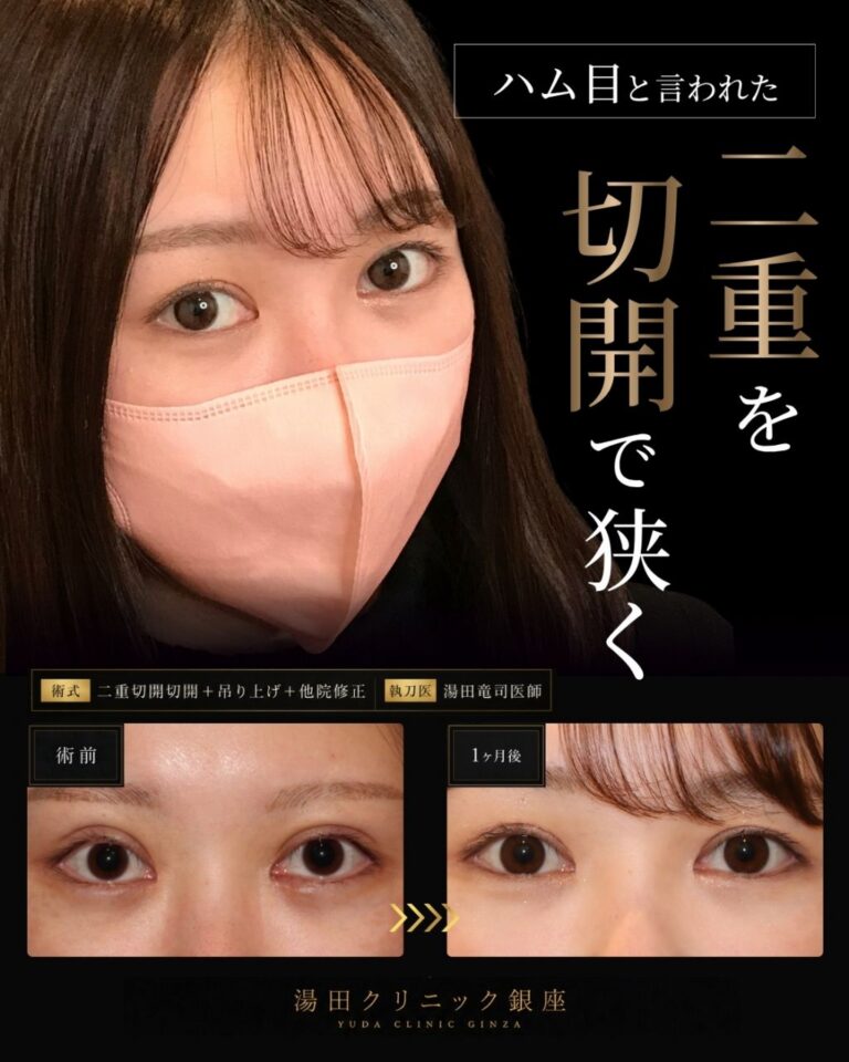 術前術後１ヶ月比較写真/ハム目・左右差を治す。二重切開修正/二重幅調整CASE I 046