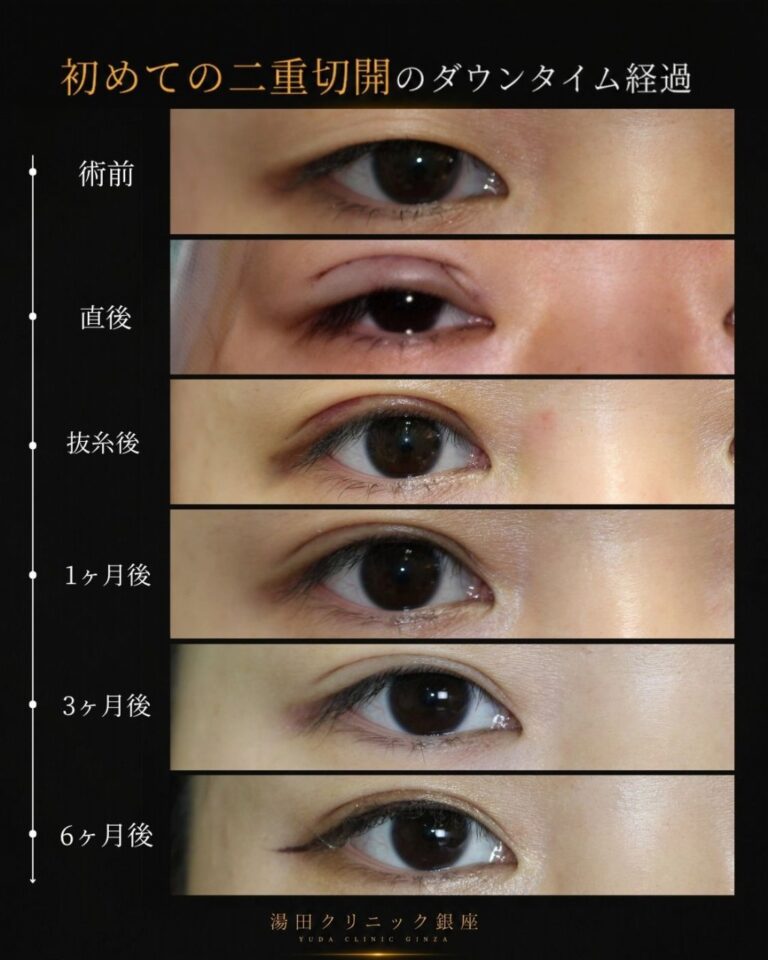 初めての二重切開術後経過６ヶ月。厚ぼったい一重まぶたをMix二重に。CASE I 189