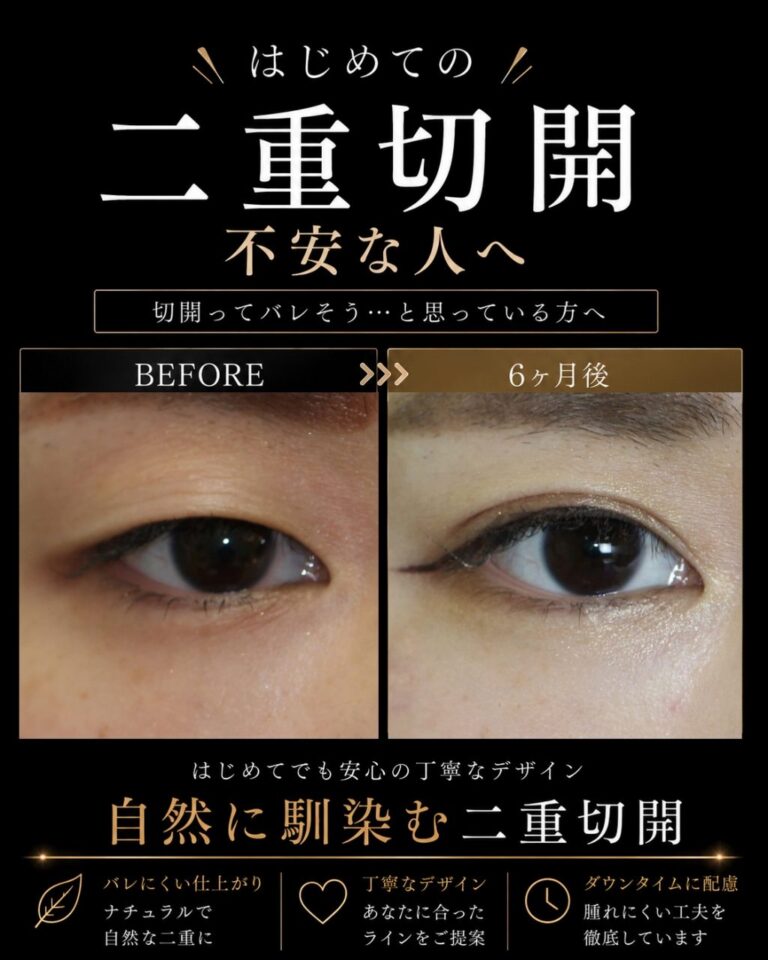 初めての二重切開術前術後６ヶ月比較写真。厚ぼったい一重まぶたをMix二重に。CASE I 189