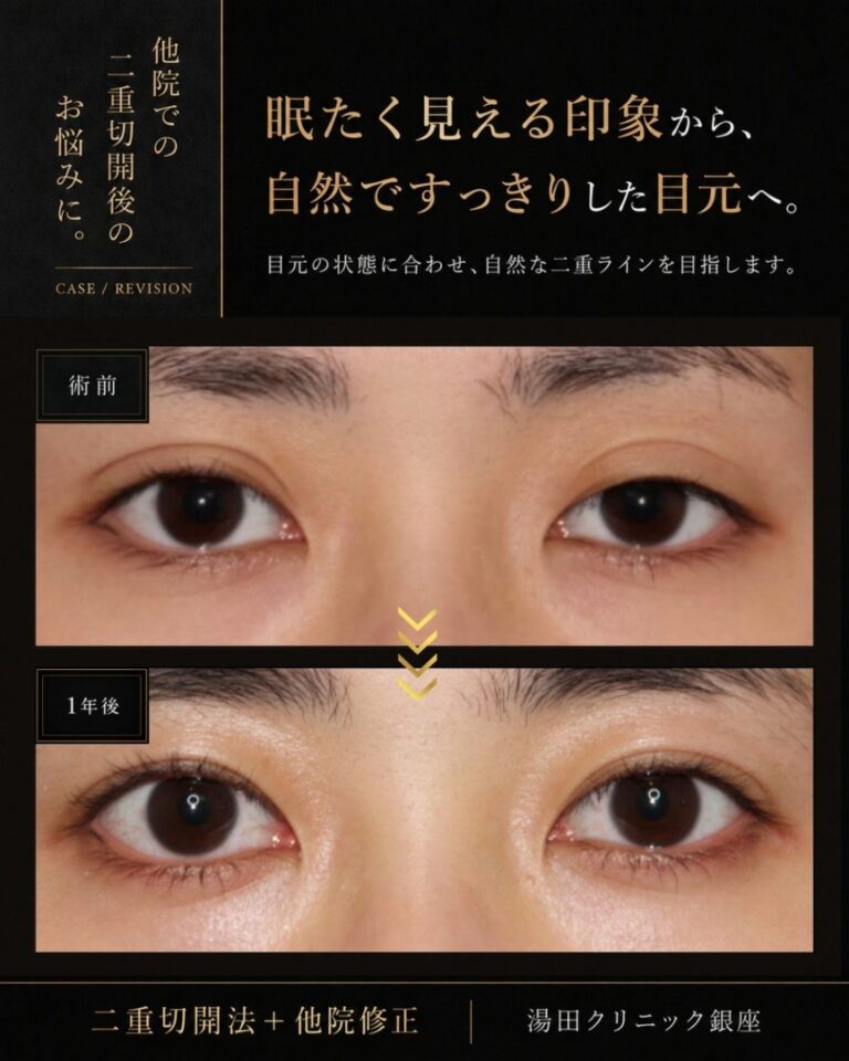 二重埋没法を繰り返し二重切開で修正した症例術後１年まで正面比較R010