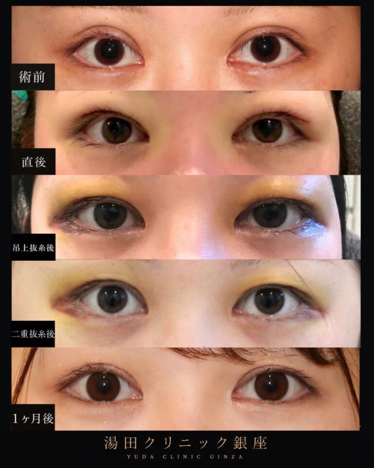 術後１ヶ月経過写真アップ/ハム目・左右差を治す。二重切開修正/二重幅調整CASE I 046