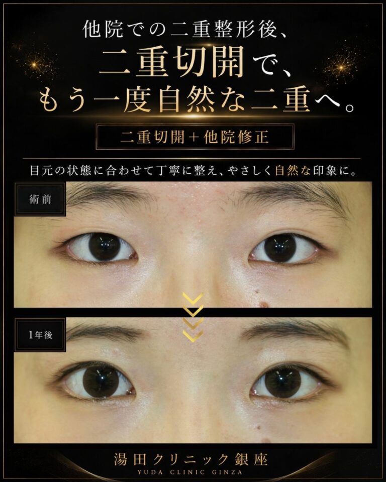 術前と術後の代表比較|予定外二重ラインと左右差の二重切開修正(他院修正)CASE RI 067
