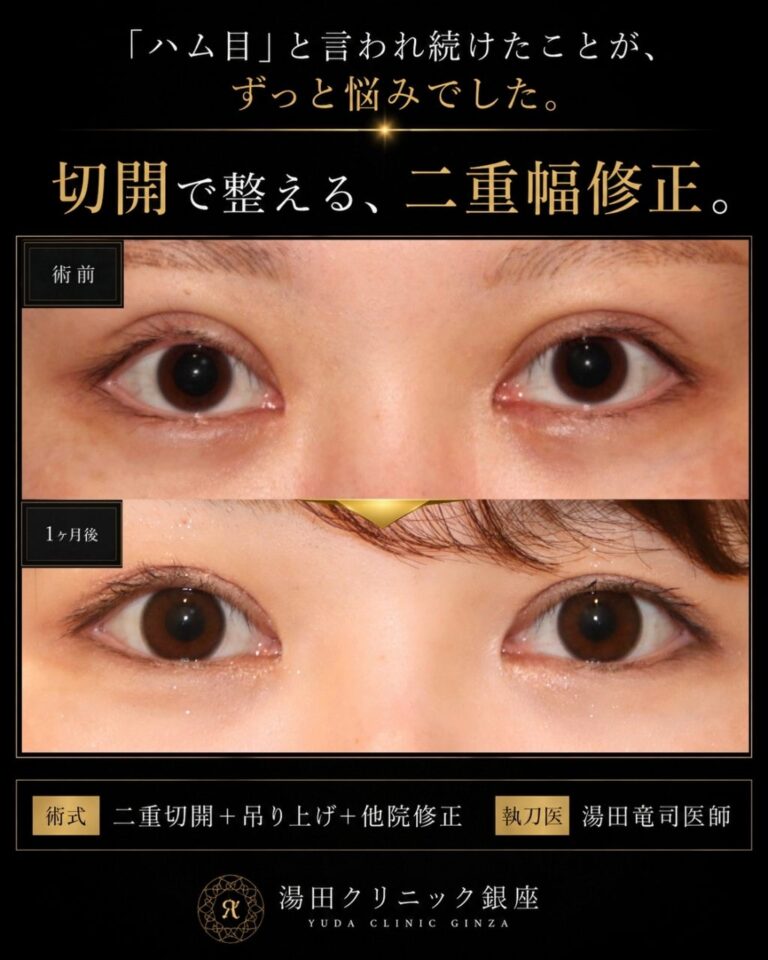 術前術後１ヶ月比較写真アップ/ハム目・左右差を治す。二重切開修正/二重幅調整CASE I 046