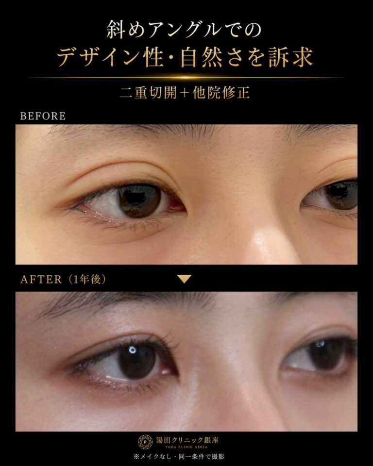 二重埋没法を繰り返し二重切開で修正した症例術後１年まで斜め比較R010