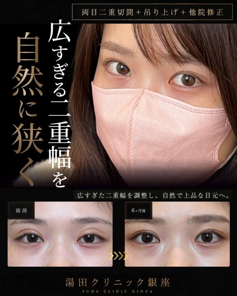 他院二重切開後の二重幅を狭くした修正症例・術前と術後の正面代表比較｜CASE 30
