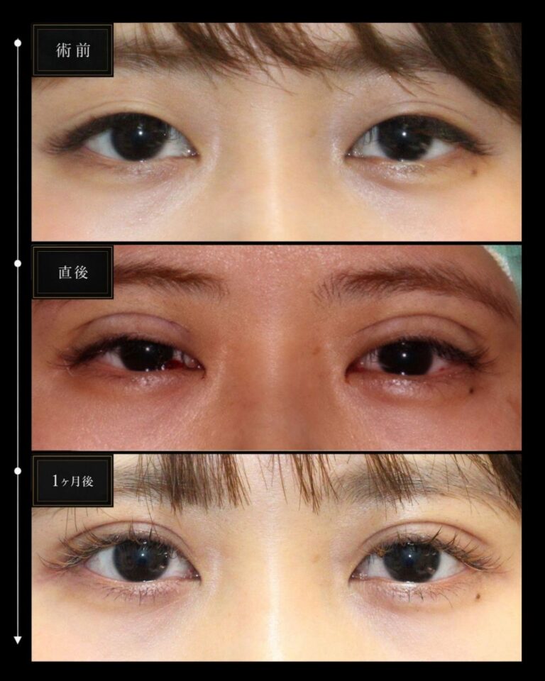 アイプチ長期間使用でまぶたかぶれあり。初めての二重整形埋没法CASE B 159・術後経過１ヶ月