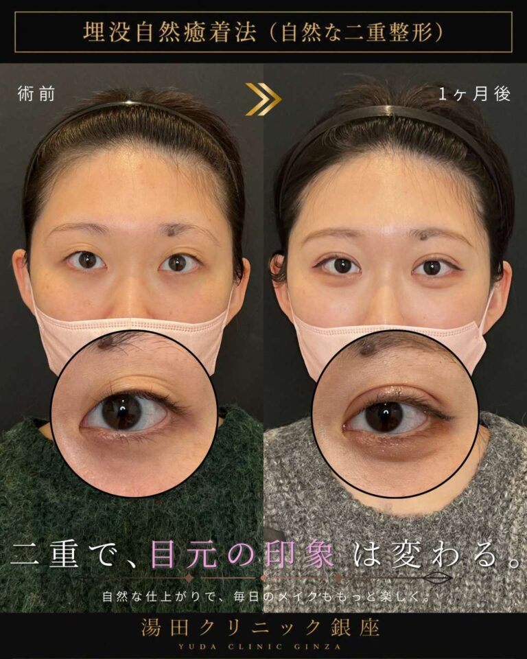 アイプチを長期間使用していた方の初めての二重整形症例・術後1ヶ月｜CASE 187