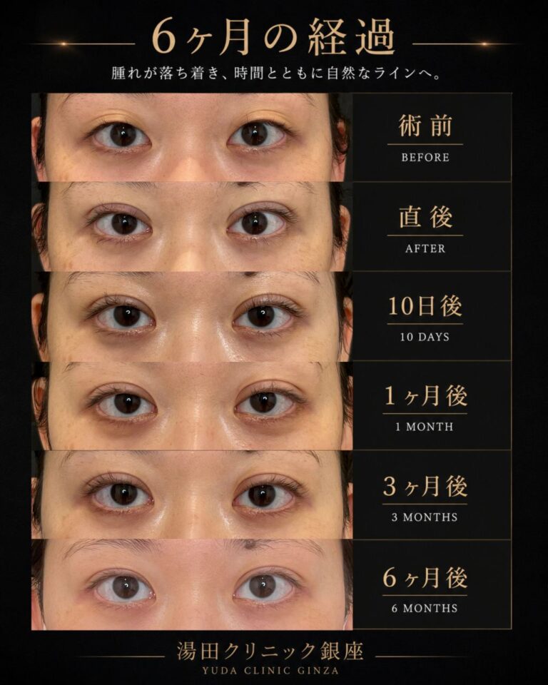 アイプチを長期間使用していた方の初めての二重整形症例・術後６ヶ月｜CASE 187