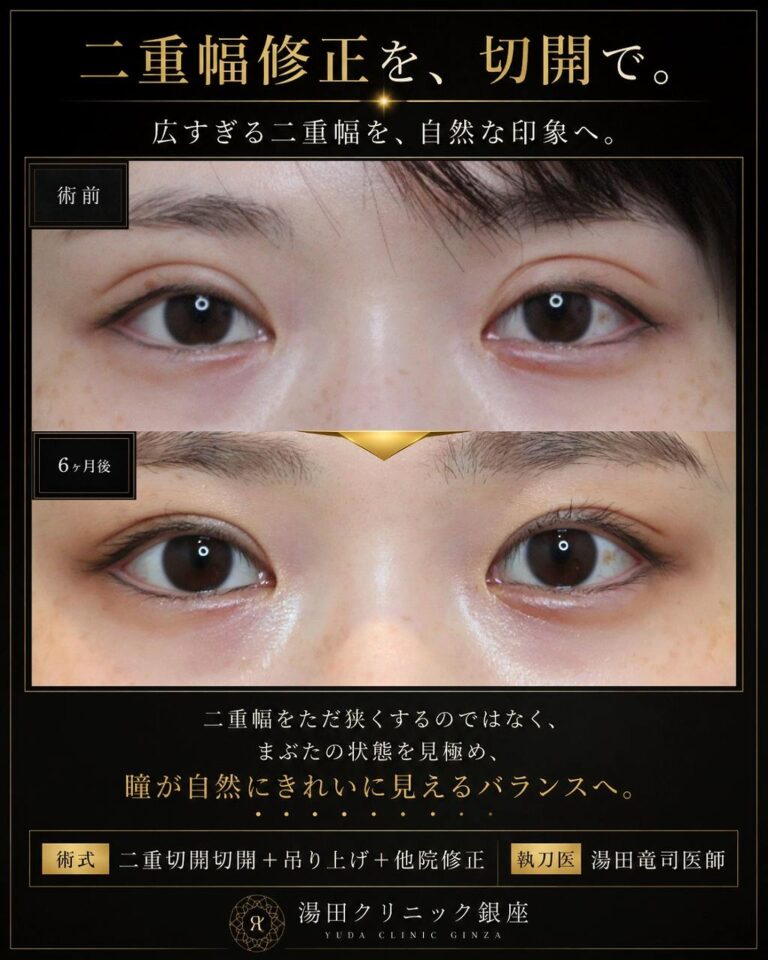 他院二重切開後の二重幅を狭くした修正症例・術前と術後の正面代表比較｜CASE 30