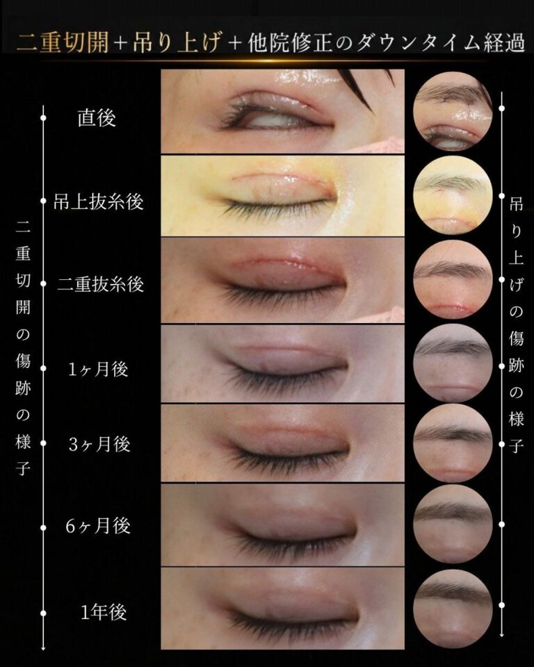 他院二重切開後の二重幅を狭くした修正症例・術後１年閉眼時傷跡｜CASE 30