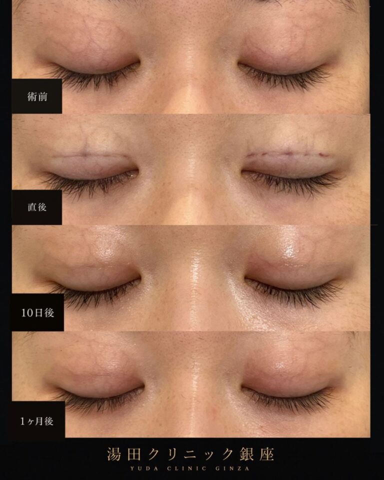 アイプチを長期間使用していた方の初めての二重整形症例・術後６ヶ月｜CASE 187