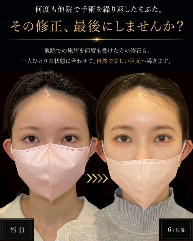 正面比較他院二重切開後 整形感のある二重幅を自然にした二重幅調整吊り上げ法併用（幅狭）CASE185