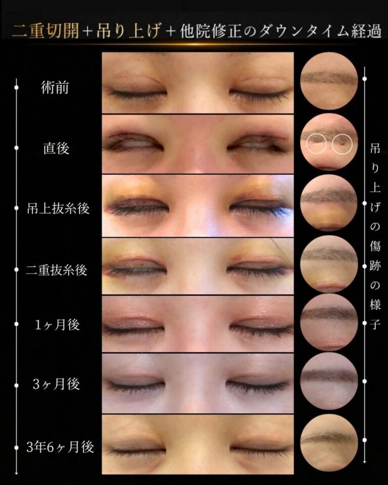 閉眼時傷跡６ヶ月経過/ハム目・左右差を治す。二重切開修正/二重幅調整CASE I 046