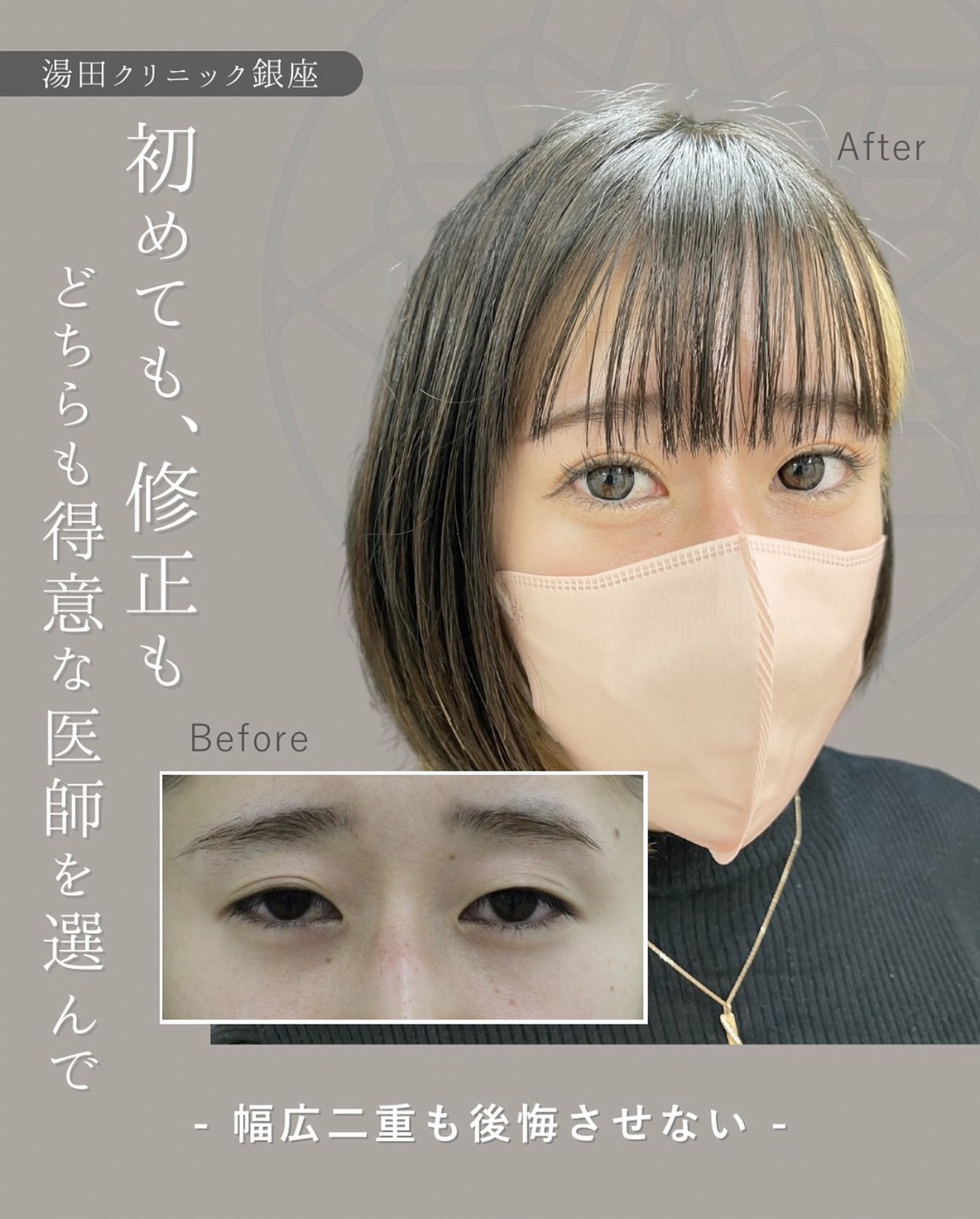二重埋没法左右差・幅調整の症例