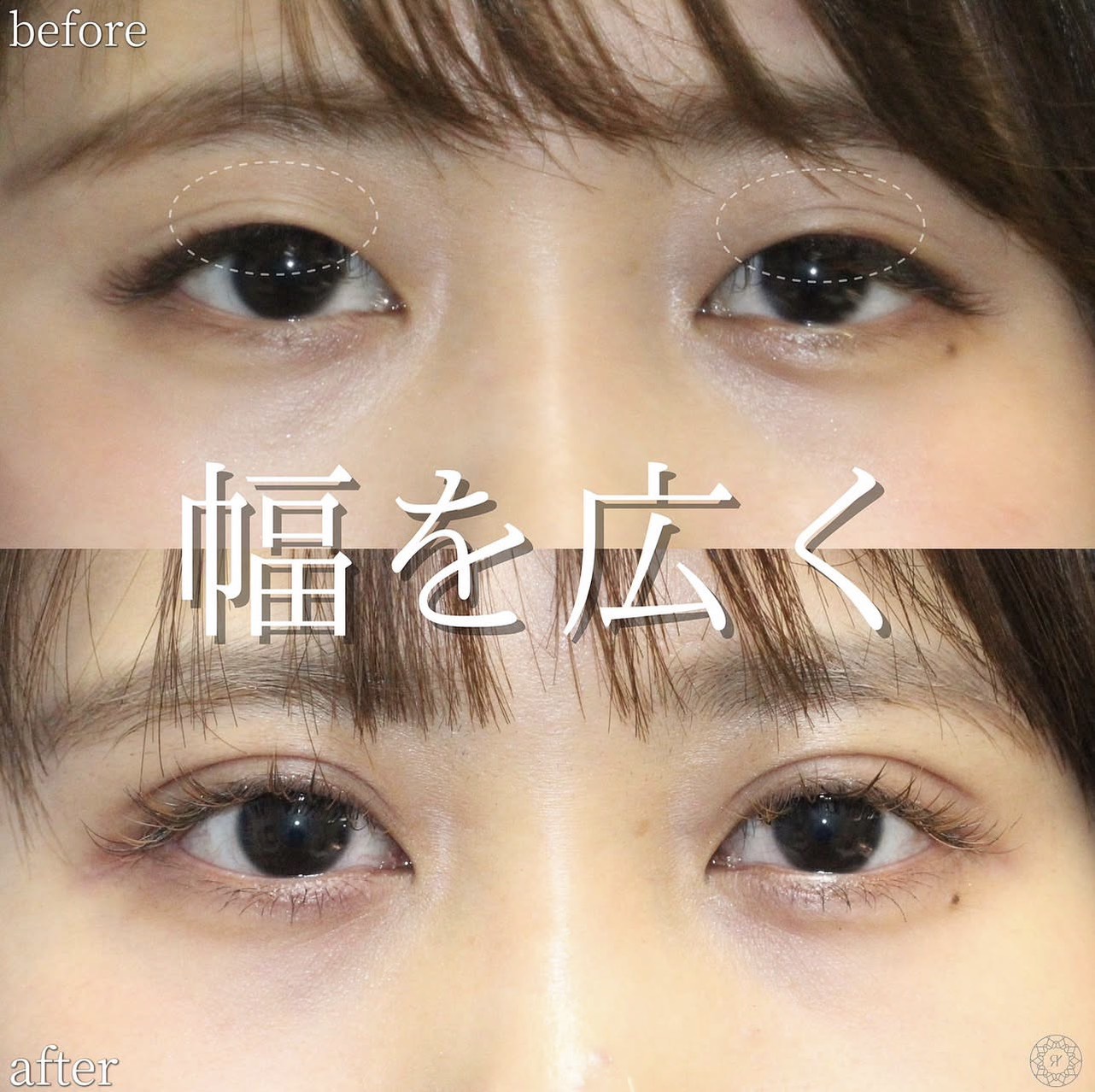 二重埋没法幅広二重にした症例