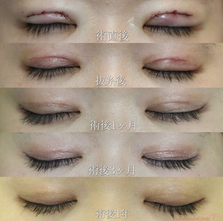 繰り返す埋没法からの初めての二重切開法術後１年経過 閉眼時傷跡｜CASE 65