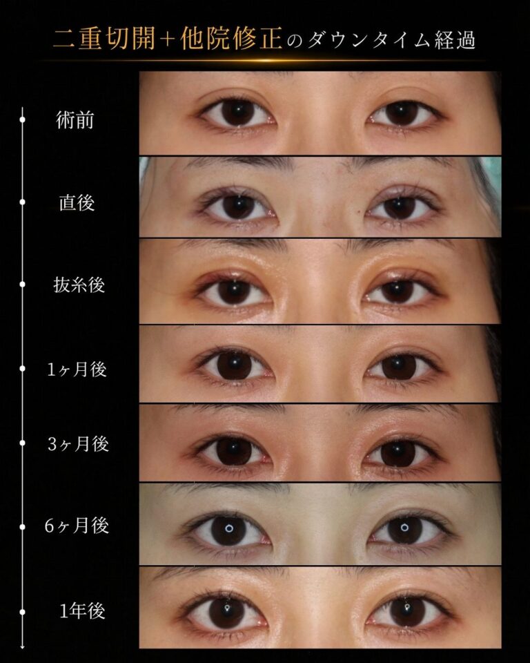 二重埋没法を繰り返し二重切開で修正した症例術後経過１年までR010