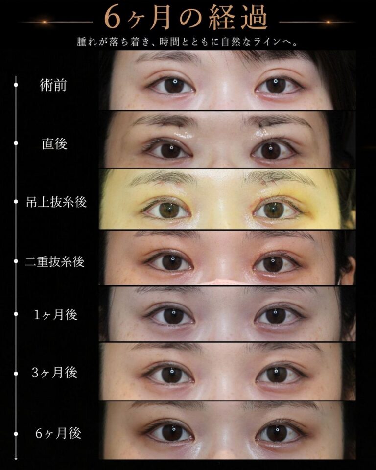 他院二重切開後の二重幅を狭くした修正症例・術後６ヶ月経過写真｜CASE 30