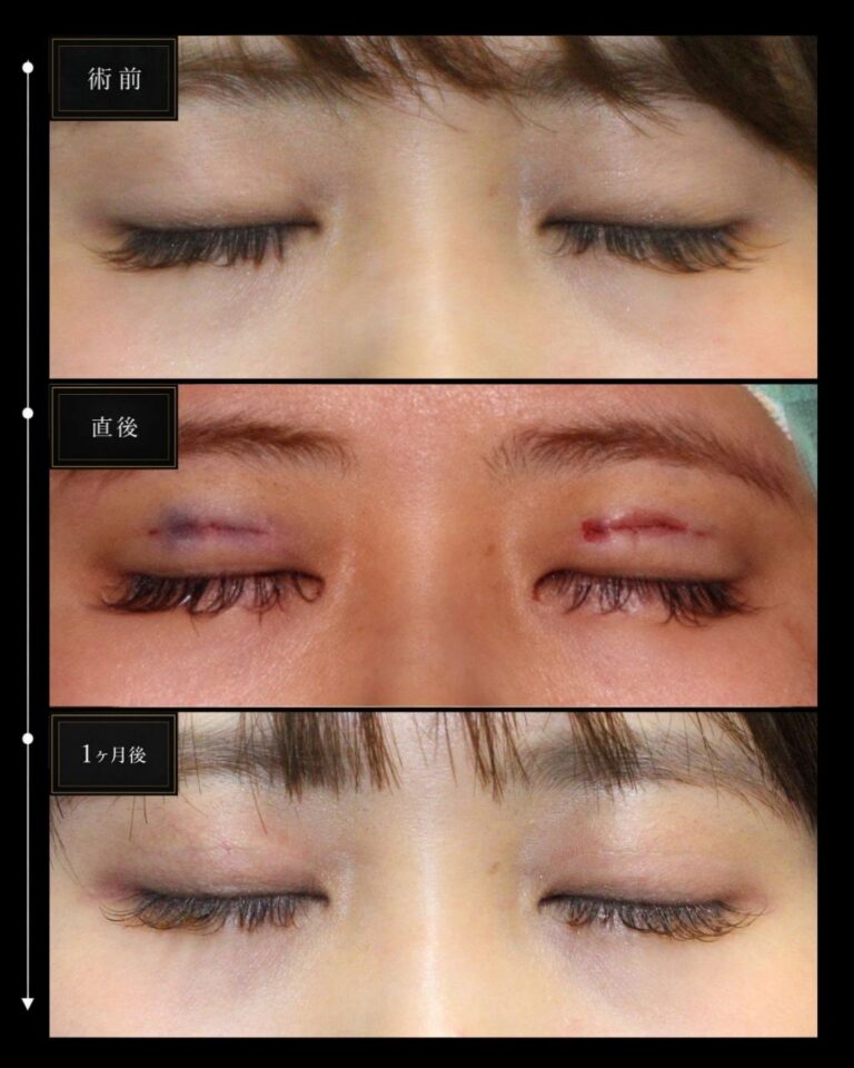 アイプチ長期間使用でまぶたかぶれあり。初めての二重整形埋没法CASE B 159・閉眼時傷跡術後経過１ヶ月