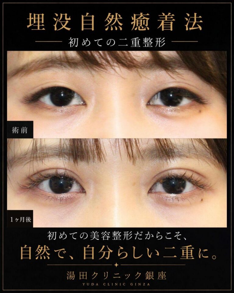 アイプチ長期間使用でまぶたかぶれあり。初めての二重整形埋没法CASE B 159・術後１ヶ月