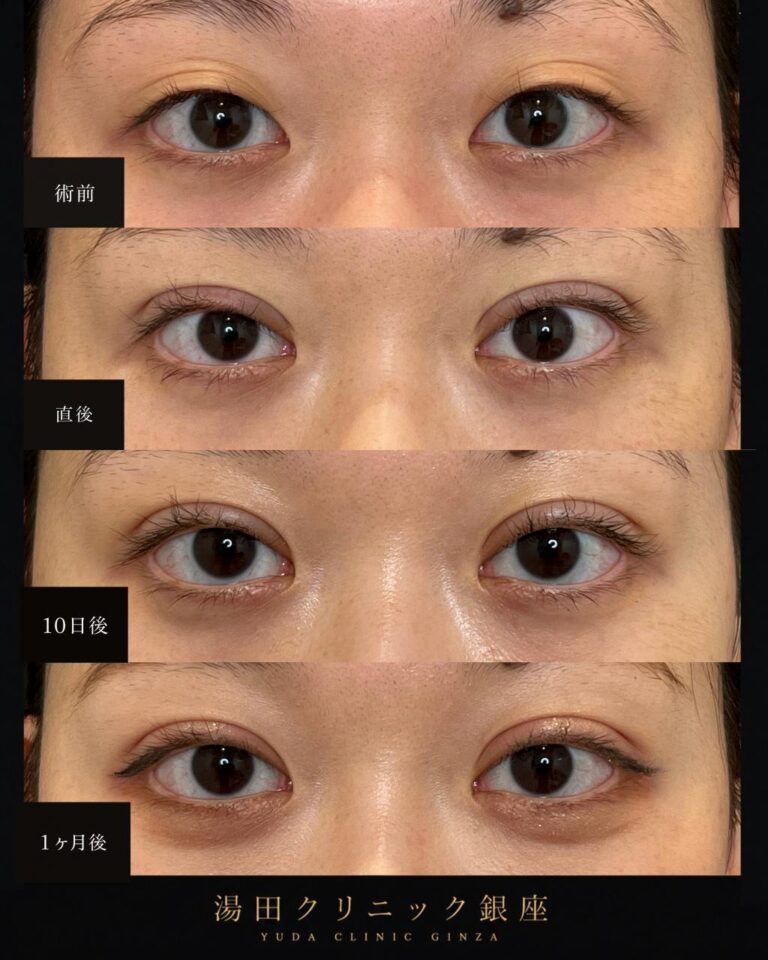 アイプチを長期間使用していた方の初めての二重整形症例・術後1ヶ月経過｜CASE 187