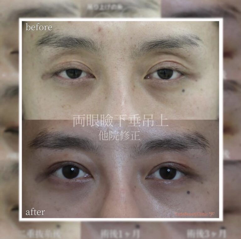 予定外線と目の開きを改善した二重切開他院修正 CASE 06の術前術後正面比較