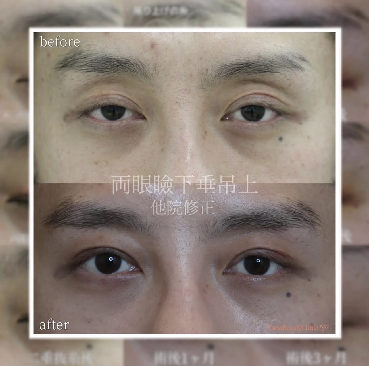予定外線と目の開きを改善した二重切開他院修正 CASE 06の術前術後正面比較