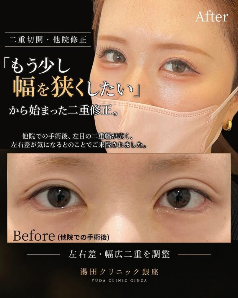 トップ　二重の左右差ハム目食い込み二重幅狭く修正 I190症例