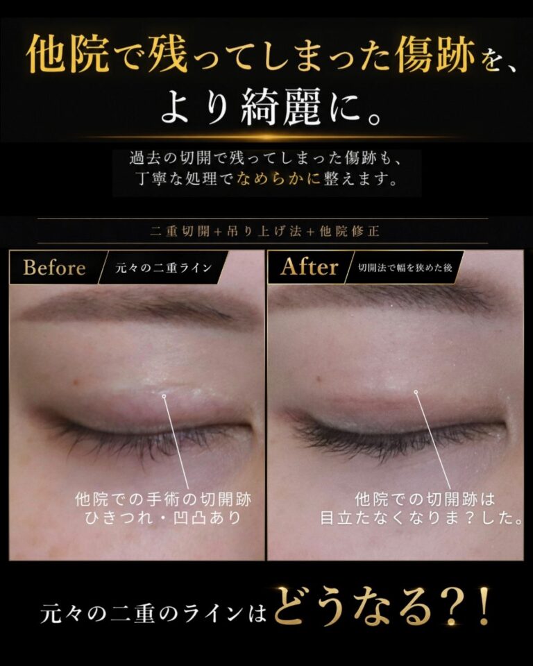 食い込みの強い不自然な幅広二重を狭く修正CaseI135