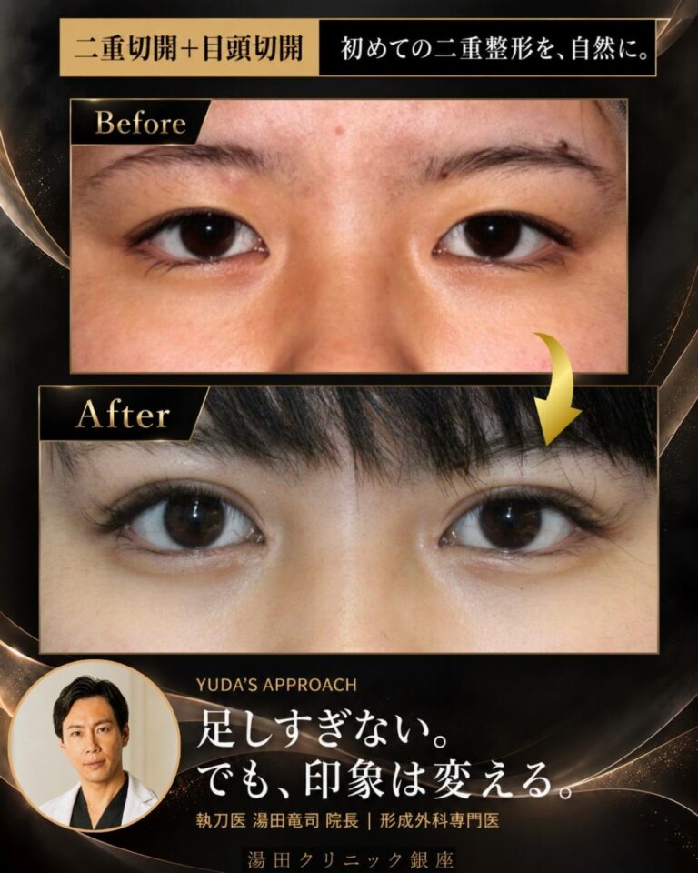 トップ 二重切開＋目頭切開症例・術前と術後の代表比較｜CASE 72