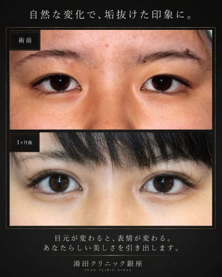 正面比較 二重切開＋目頭切開症例・術前と術後の代表比較｜CASE 72