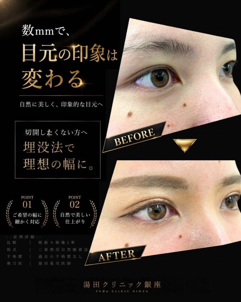 厚ぼったい瞼。二重幅を広くパッチリ二重にしたいCASE B 004