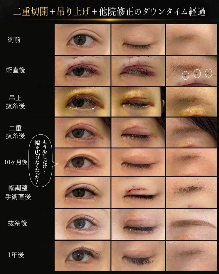術後経過 二重の左右差ハム目食い込み二重幅狭く修正 I190症例