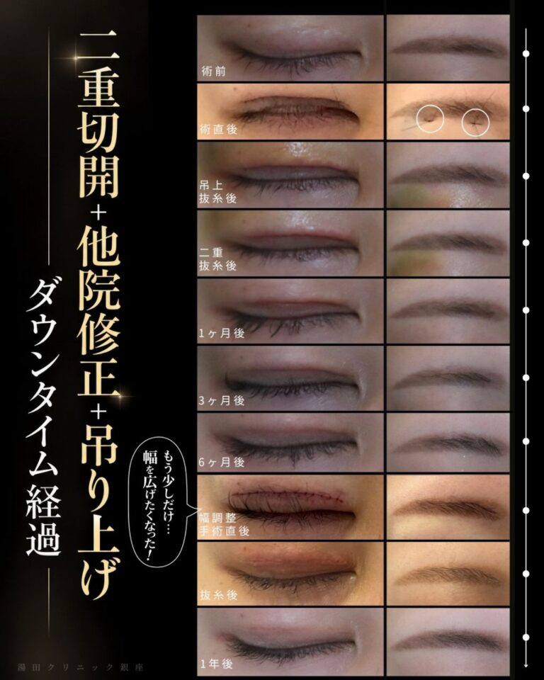 食い込みの強い不自然な幅広二重を狭く修正CaseI135