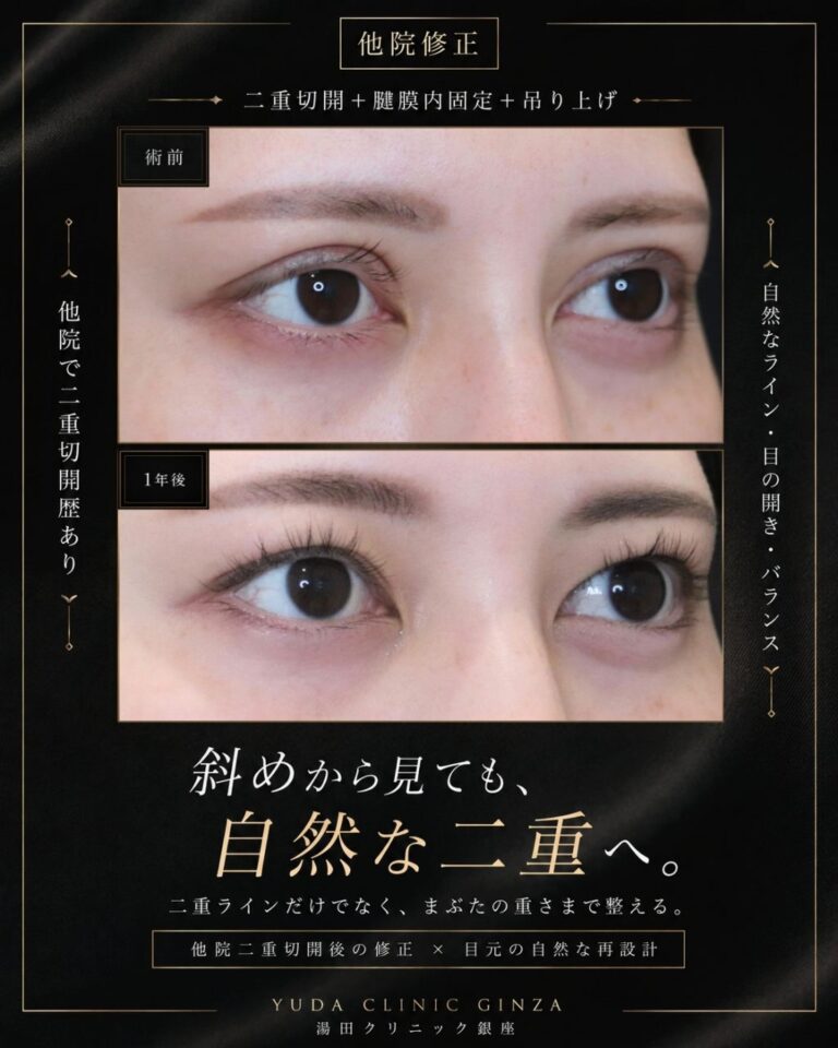 食い込みの強い不自然な幅広二重を狭く修正CaseI135