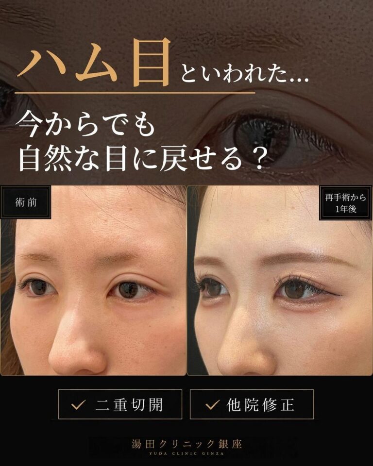 斜め比較 二重の左右差ハム目食い込み二重幅狭く修正 I190症例