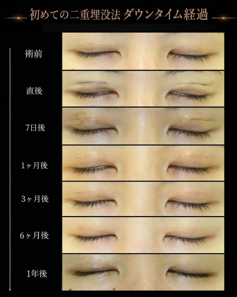 厚ぼったい瞼。二重幅を広くパッチリ二重にしたいCASE B 004