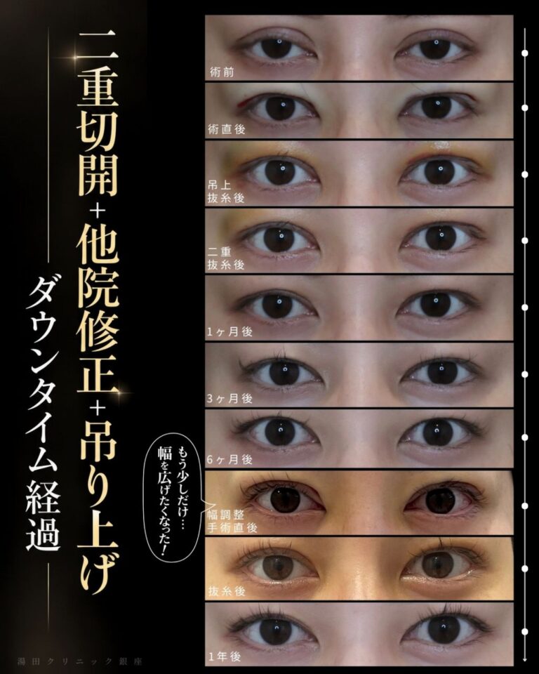 食い込みの強い不自然な幅広二重を狭く修正CaseI135